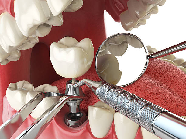 Best Emergency Treatment for Toothache in Five Forks, SC